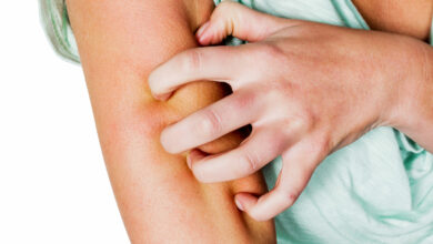 Bigstock A Woman Has After A Mosquito B 73039933 Scaled 390x220